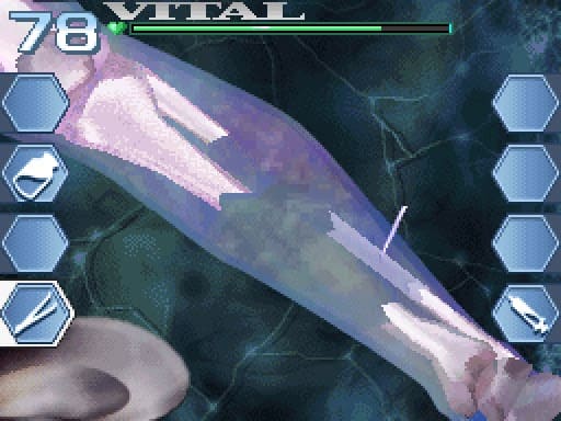 A fractured bone is shown in a surgical interface, with tools and visual indicators used to align and repair the break.